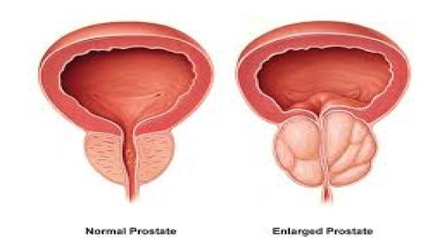 صحتي/مرض البروستات